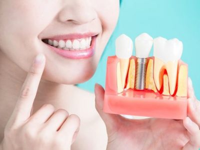 Trồng răng implant đem lại nụ cười tự tin
