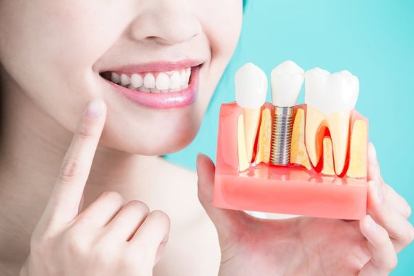Trồng răng implant đem lại nụ cười tự tin 