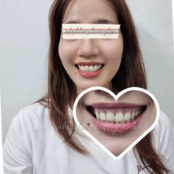 Top 12 địa chỉ trồng răng implant tốt uy tín nhất tại Tân Phú TP HCM