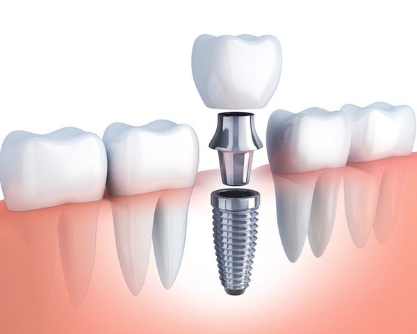 Dịch vụ trồng răng implant chất lượng cao 