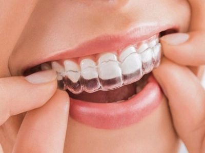 Top 7+ địa chỉ niềng răng thẩm mỹ uy tín Tp.HCM